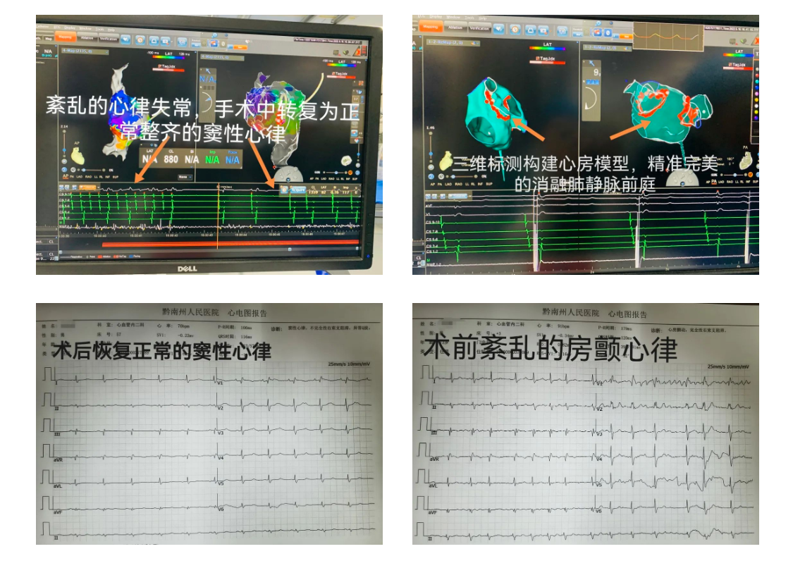 黔南州人民醫院成功實施消融左心耳封堵房缺封堵手術