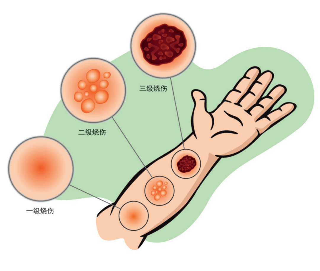 动静健康 | 遭遇烫伤、烧伤,我们到底应该怎么办?