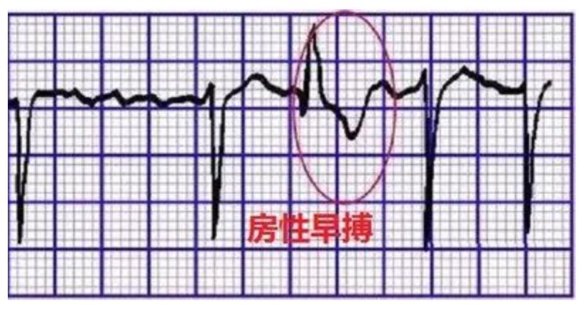 早搏的心电图表现图片