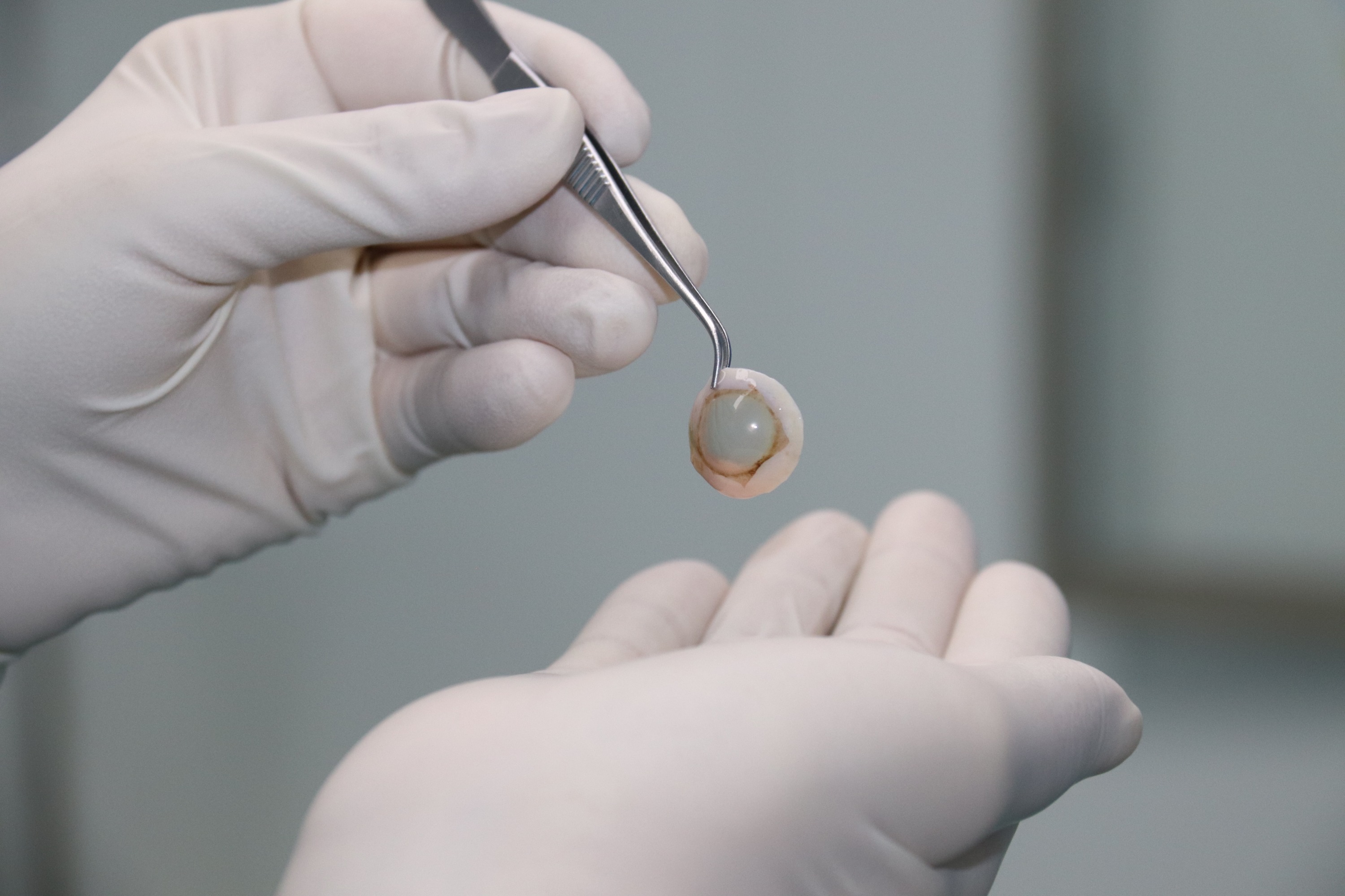 贵州普瑞眼科医院角膜移植"快车道 "让角膜病患者不再"望眼欲穿"