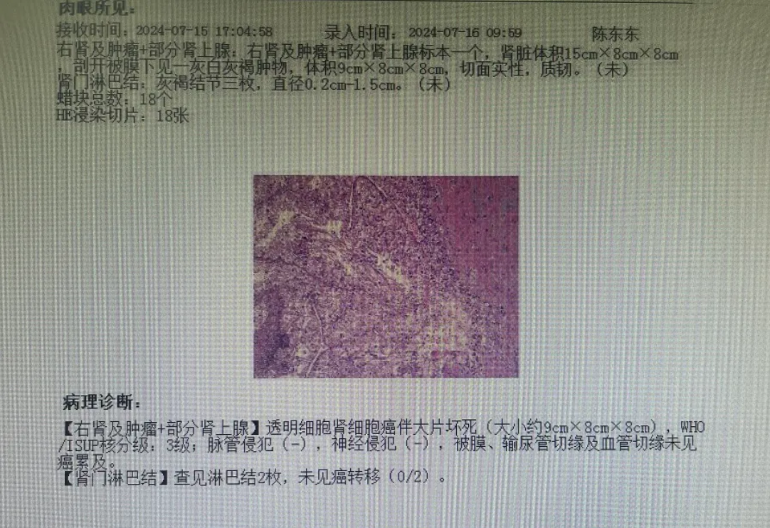 肾癌检查报告图片