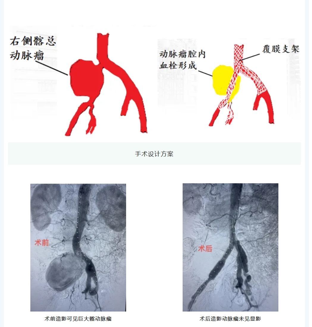 股动脉假性动脉瘤图片